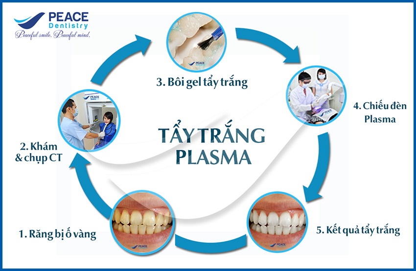 1_Tay trang rang Plasma