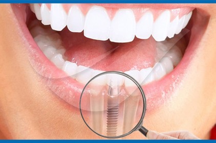 Tại sao implant ưu việt hơn cầu răng?