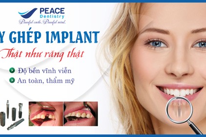 Có nên lựa chọn cấy ghép implant để trồng răng không?