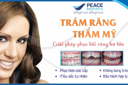 Trám răng thẩm mỹ