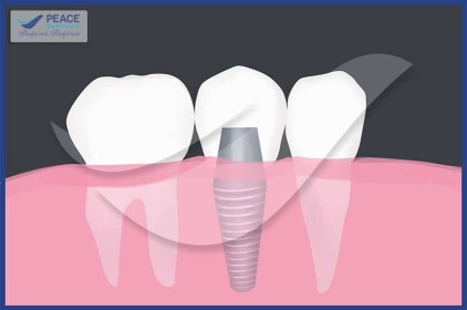 dental-implant