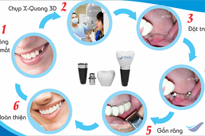 quy trình cấy ghép implant