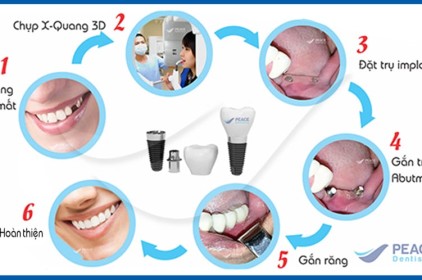 Quy trình cấy ghép implant tại Tp HCM