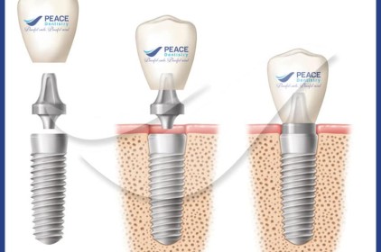 răng implant