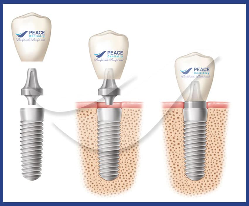 răng implant