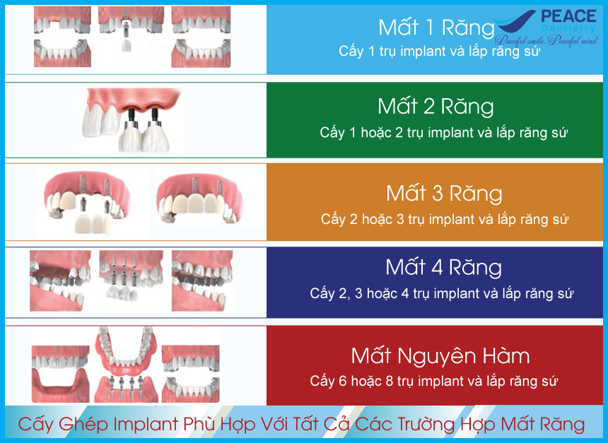 trong-rang-implant