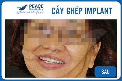 Thời gian cấy ghép implant nhanh nhất là bao lâu?