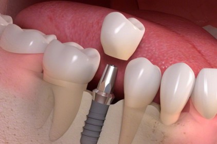 Trồng răng hàm Implant giá bao nhiêu?