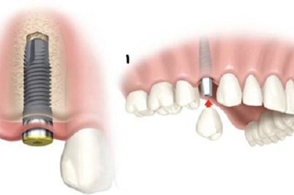 Thời điểm thích hợp để trồng răng giả