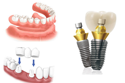 Phục hình trồng răng giả khi mất một răng cửa