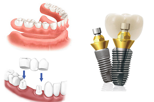 Phục hình trồng răng giả khi mất một răng cửa