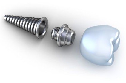 Cấu tạo đặc biệt của răng implant