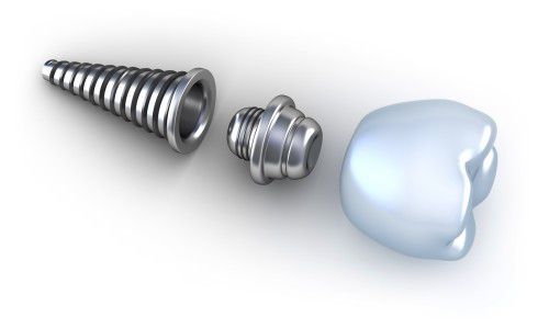 Cấu tạo đặc biệt của răng implant 