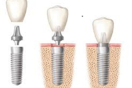 Cấu tạo đặc biệt của răng implant