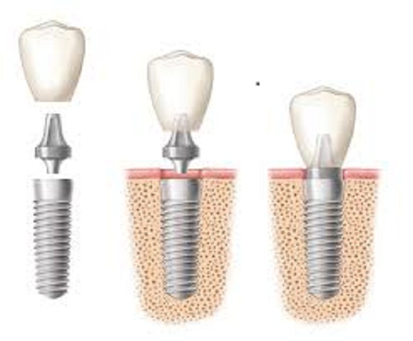 Cấu tạo đặc biệt của răng implant