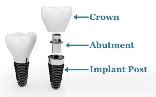 cau-tao-dac-biet-cua-rang-implant