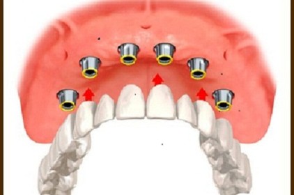 Mất răng toàn hàm có thể cấy ghép implant được không