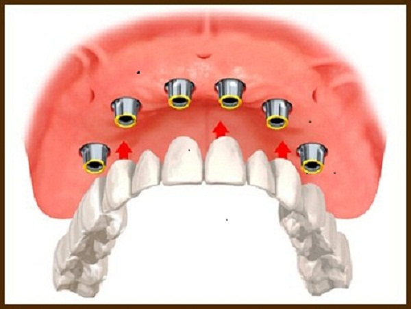 Mất răng toàn hàm có thể cấy ghép implant được không