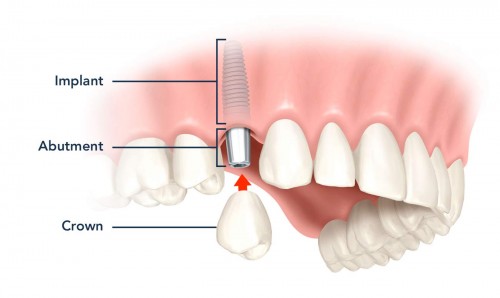 Tại sao giá cấy ghép implant cao hơn hàm tháo lắp