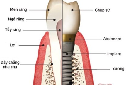 Tại sao giá cấy ghép implant cao hơn hàm tháo lắp