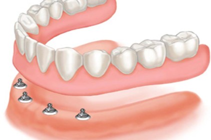 Có thể bạn chưa biết về cách trồng răng giả nguyên hàm"