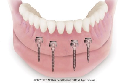 Hiệu quả bất ngờ khi cấy ghép mini implant