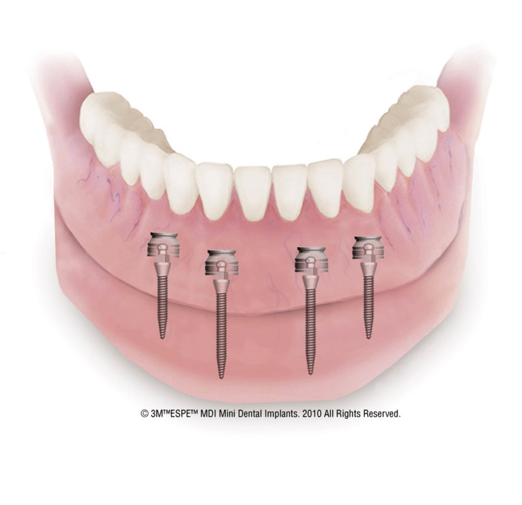 Hiệu quả bất ngờ khi cấy ghép mini implant