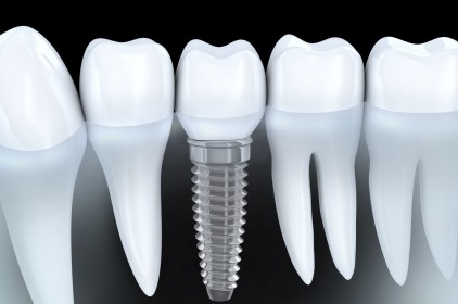 4 tác dụng không thể bỏ qua của trồng răng implant