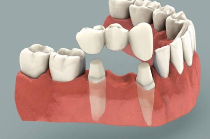 Trồng răng giá bao nhiêu theo phương pháp cầu răng sứ