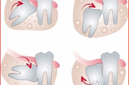 Tại sao nên nhổ răng số 8 mọc lệch?