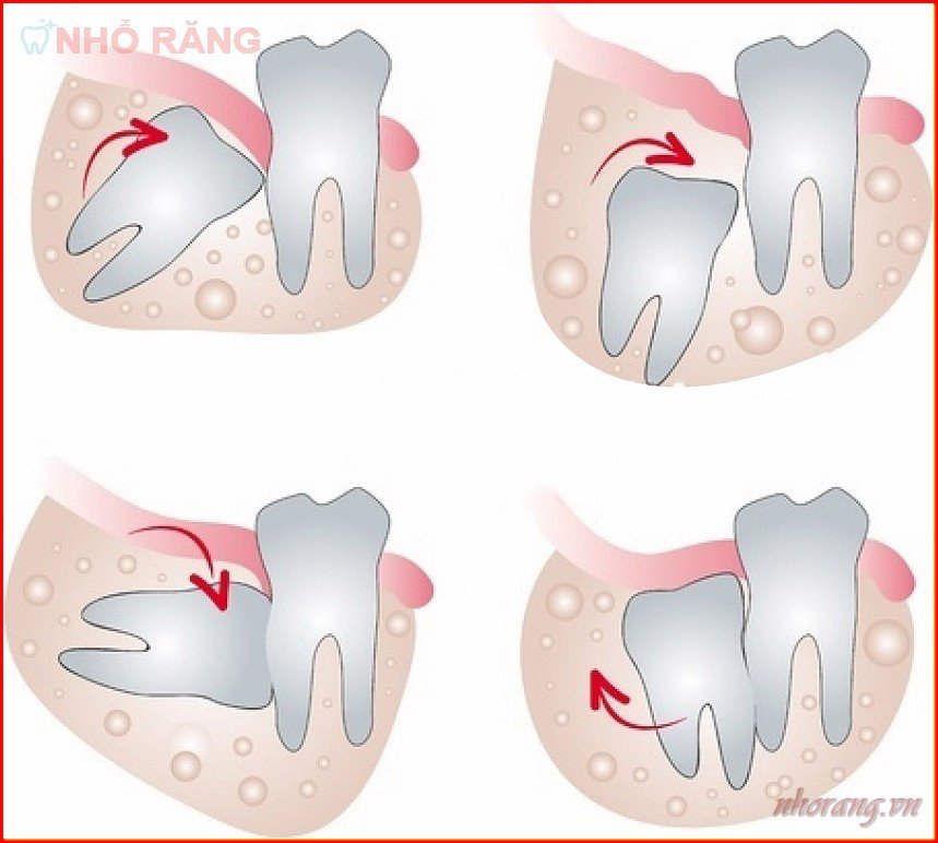 Tại sao nên nhổ răng số 8 mọc lệch?