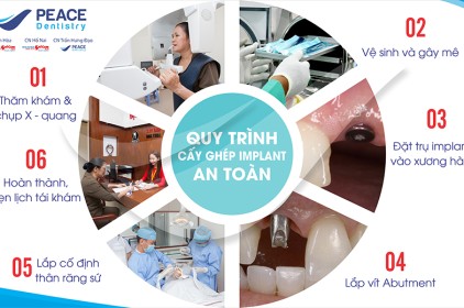 Quy trình trồng răng implant tại nha khoa Peace Dentistry