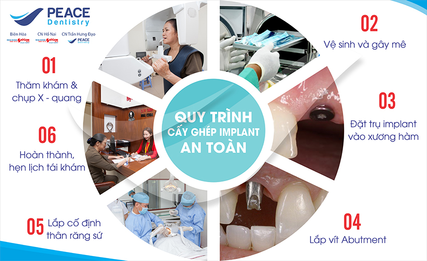 Quy trình trồng răng implant tại nha khoa Peace Dentistry