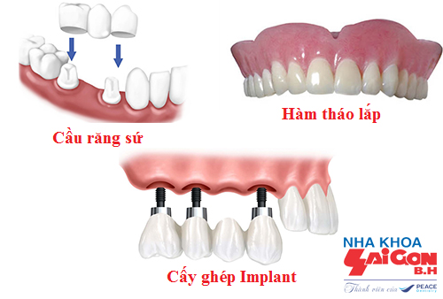 cac bien phap trong rang su