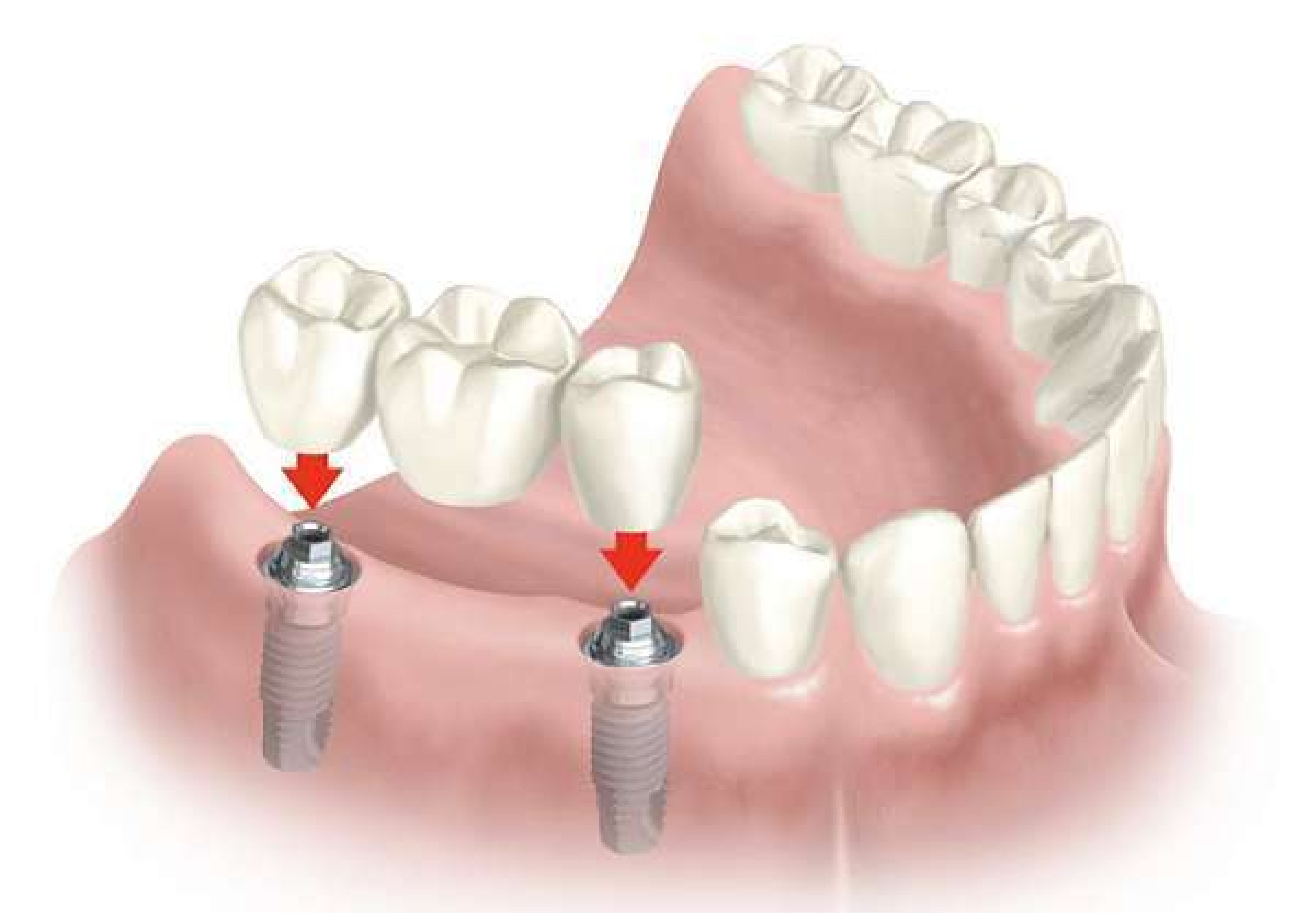 Trồng răng Implant thay thế nhiều răng