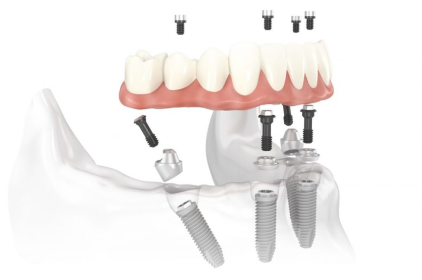 Trồng cấy ghép răng implant THẨM MỸ AN TOÀN tại Peace Dentistry