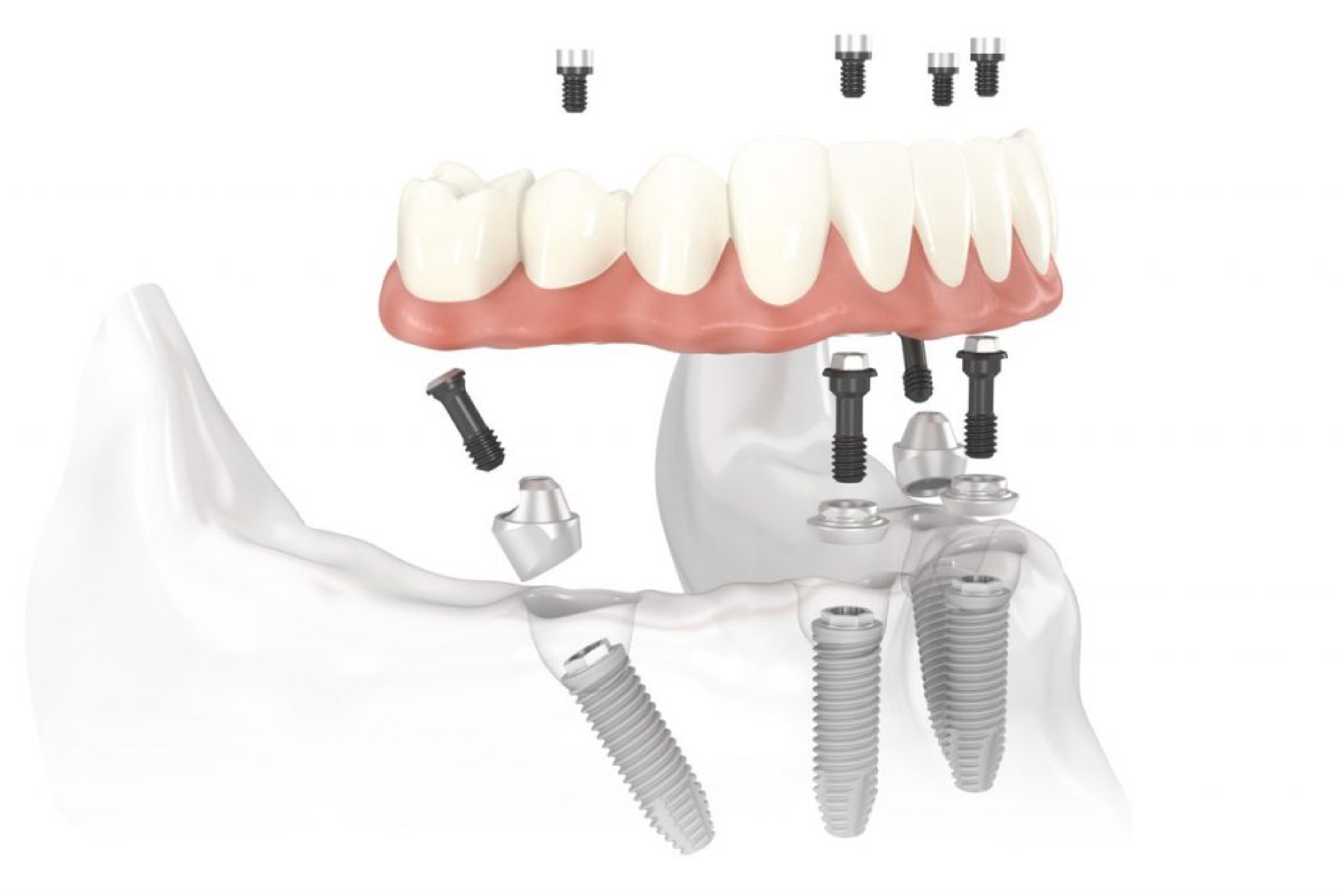 Trồng răng Implant toàn hàm